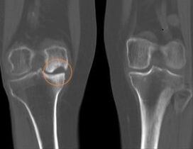 Arthrosis of the right knee