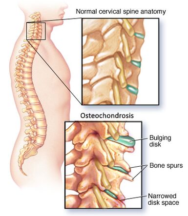 cervix osteochondrosis