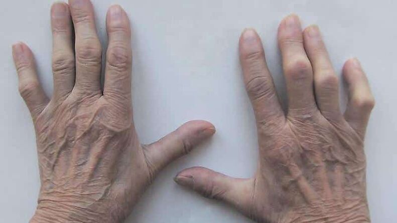 Methods of treating pain in the fingers