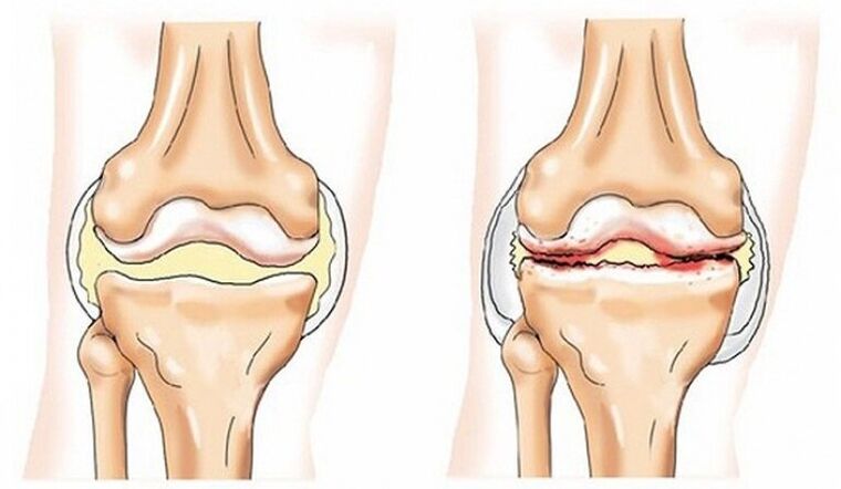 A healthy joint and joint affected by joint migration