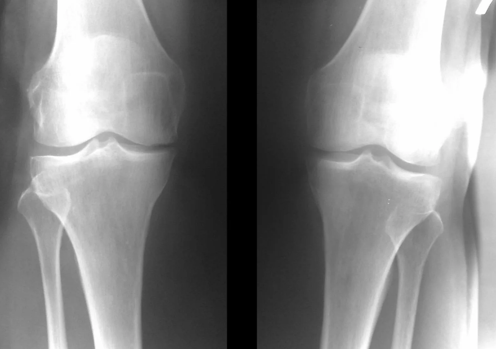 diagnosis of arthrosis of the knee joint