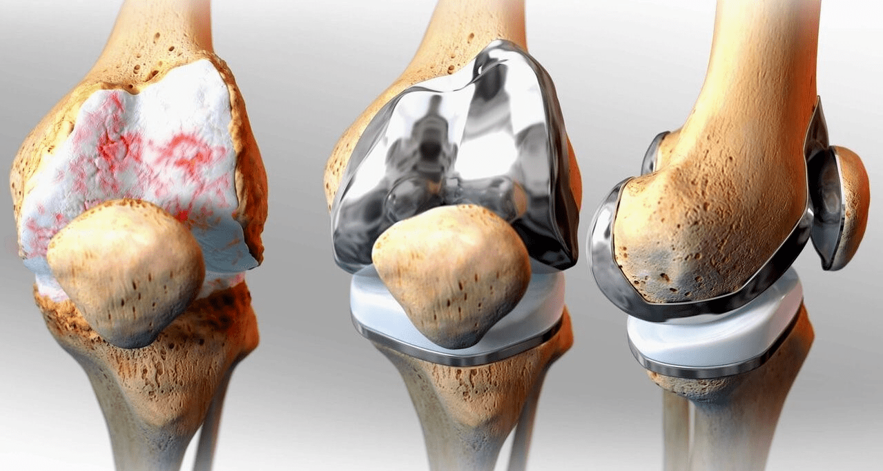 knee replacement