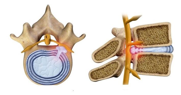 Intervertebral disc herniation – protrusion of the core of the disc into the spinal canal